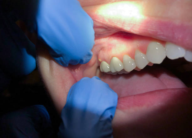 Best Emergency Wisdom Teeth Removal in Atlantic, IA